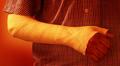 Broken Arm!