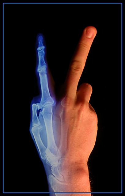 X-Rays (Accidentally Discovered in 1895)