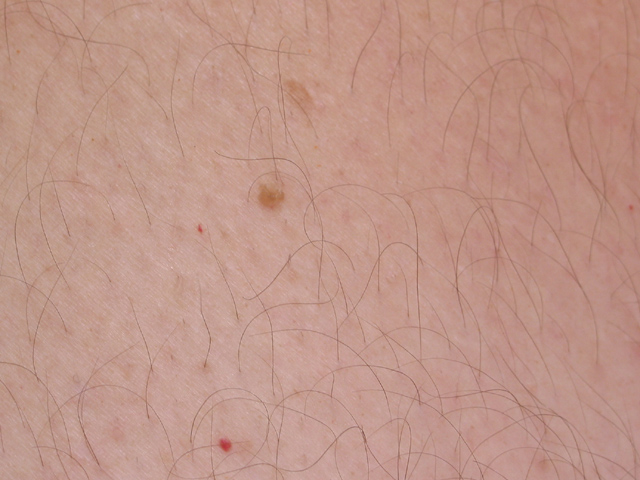 Skin Cancer?