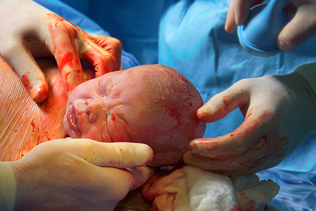 Helping Hands (C-Section)