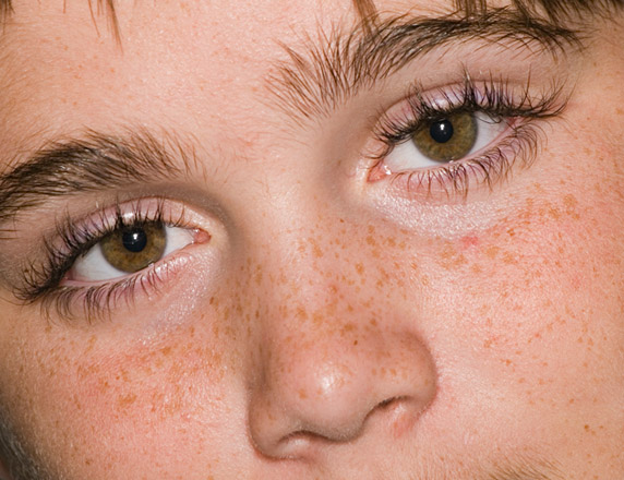 Freckles