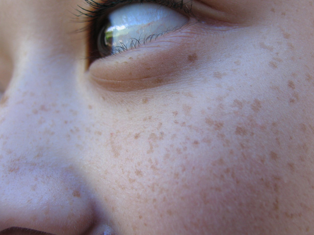 Freckles