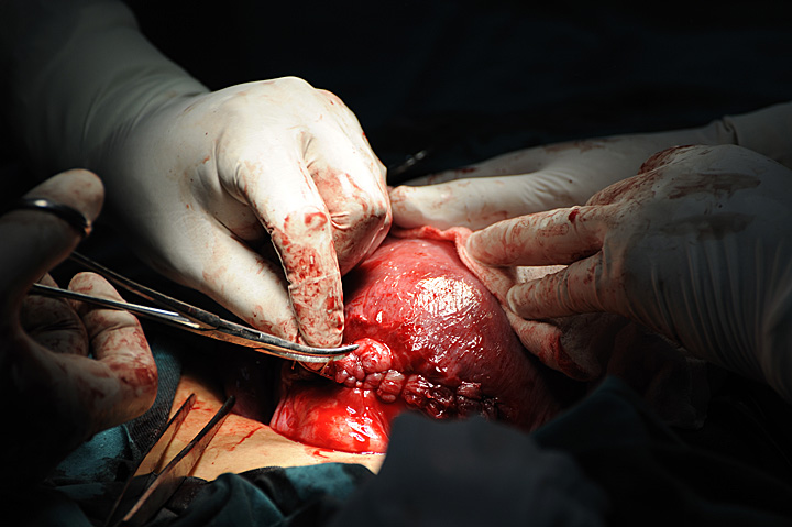 Suturing the Uterus shut