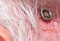 Titanium Skull Implant