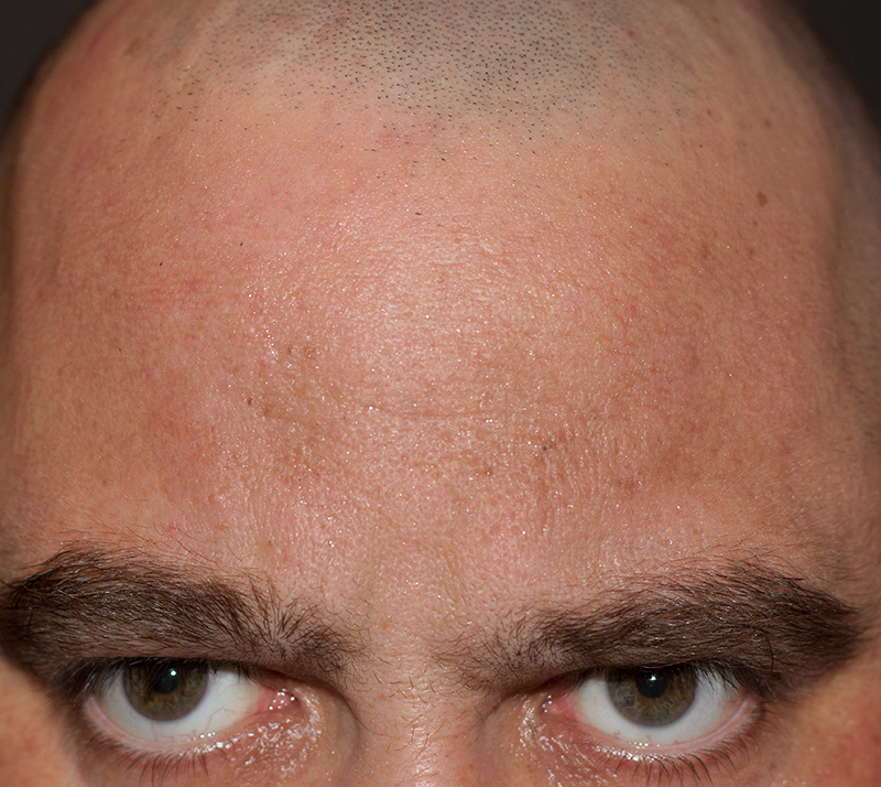 Phthiriophobia- Fear of lice