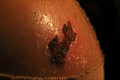 eschar emulation - take an image of a scab, so beatifully that we all want grass-burns