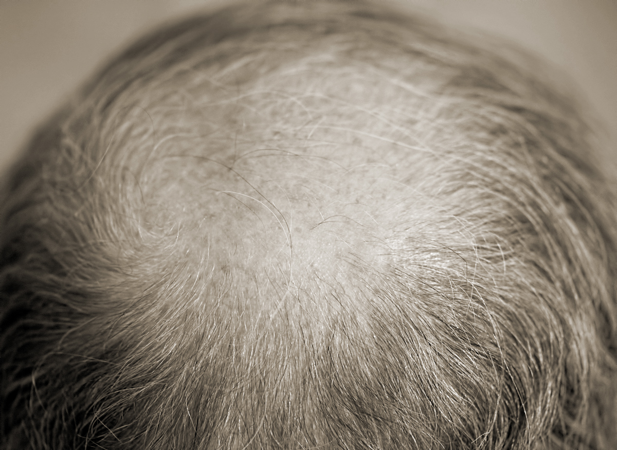 Male Pattern Baldness