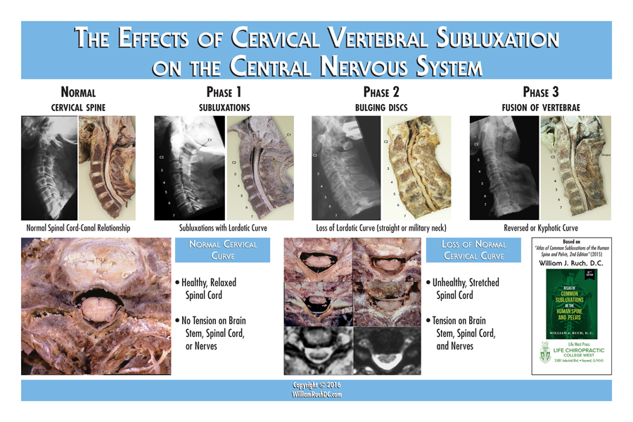 01 The Effects of Cervical Vertebral Subluxation ...
