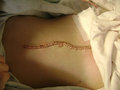 Zachery's (son) incision