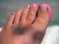 Broken Foot_filtered.jpg
