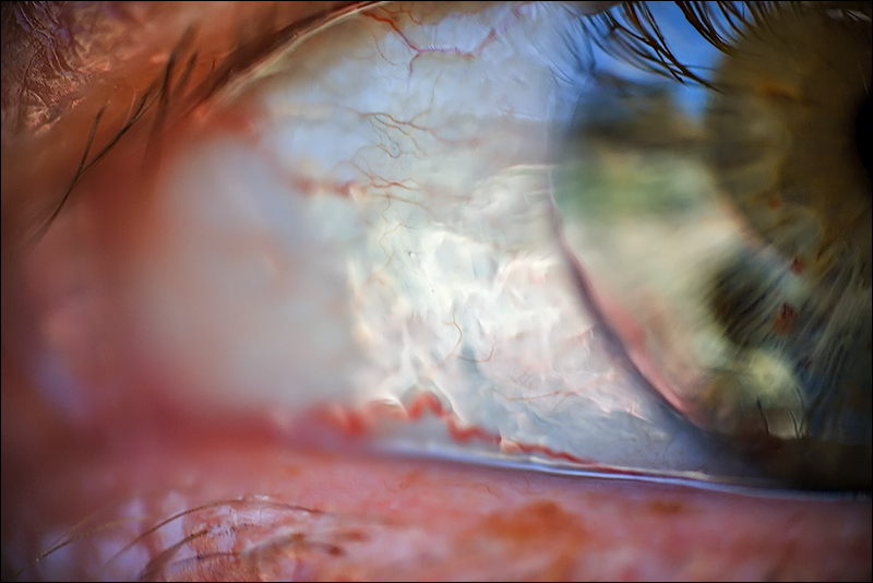 ½ of a Puzzled Eye