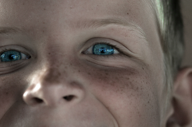 Freckles