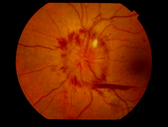 Papilledema.jpg