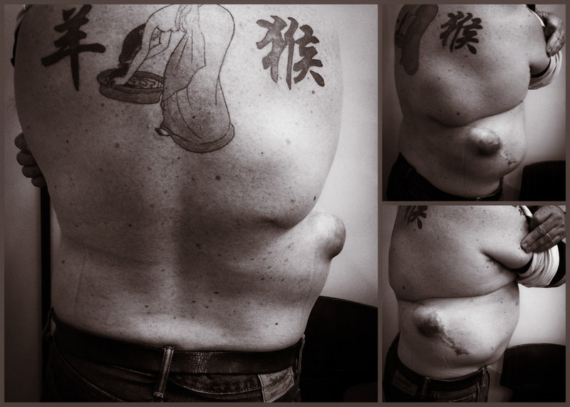 June 2012, before 3rd surgery.