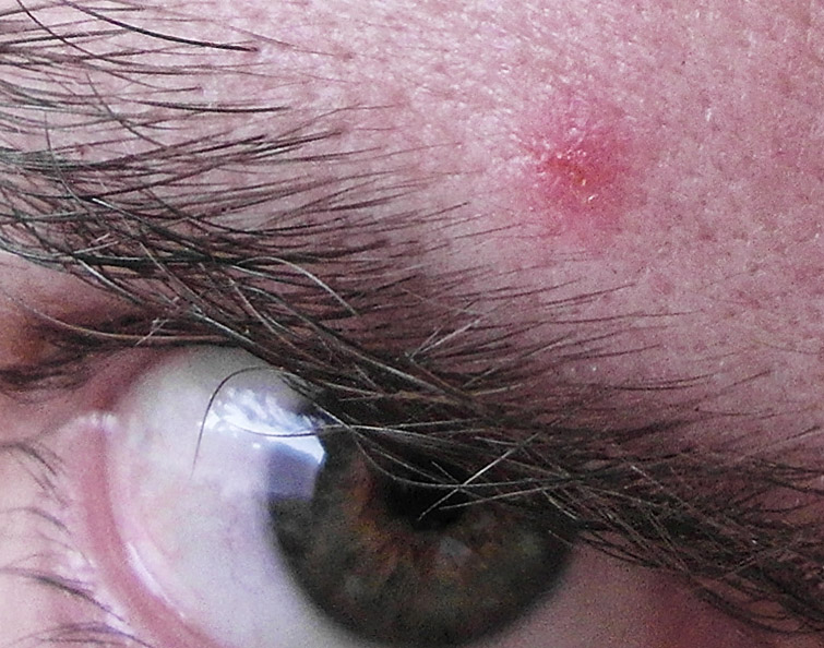 zit