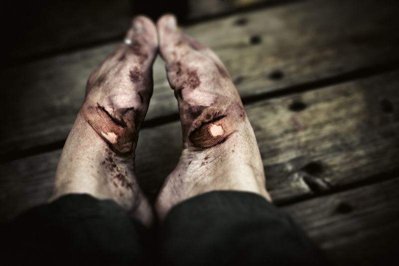 Scars