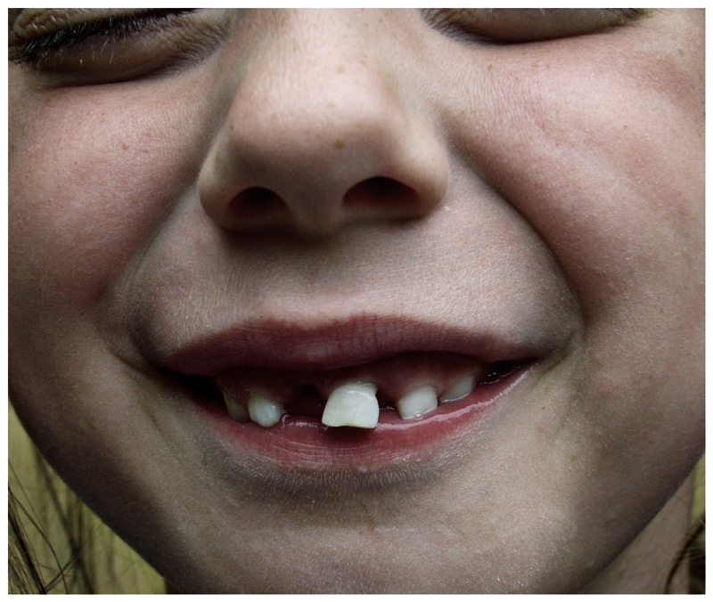 TeETh