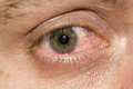 Pink Eye Sucks