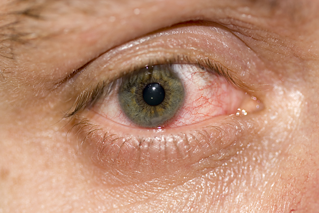 Pink Eye Sucks