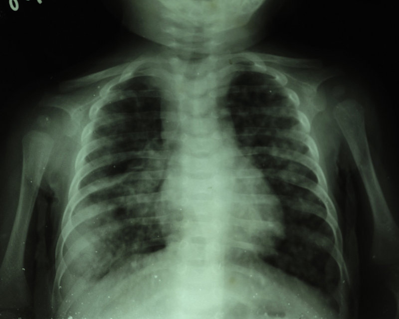 X-Ray of the 6 month old with TB