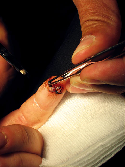 Beck's stitches