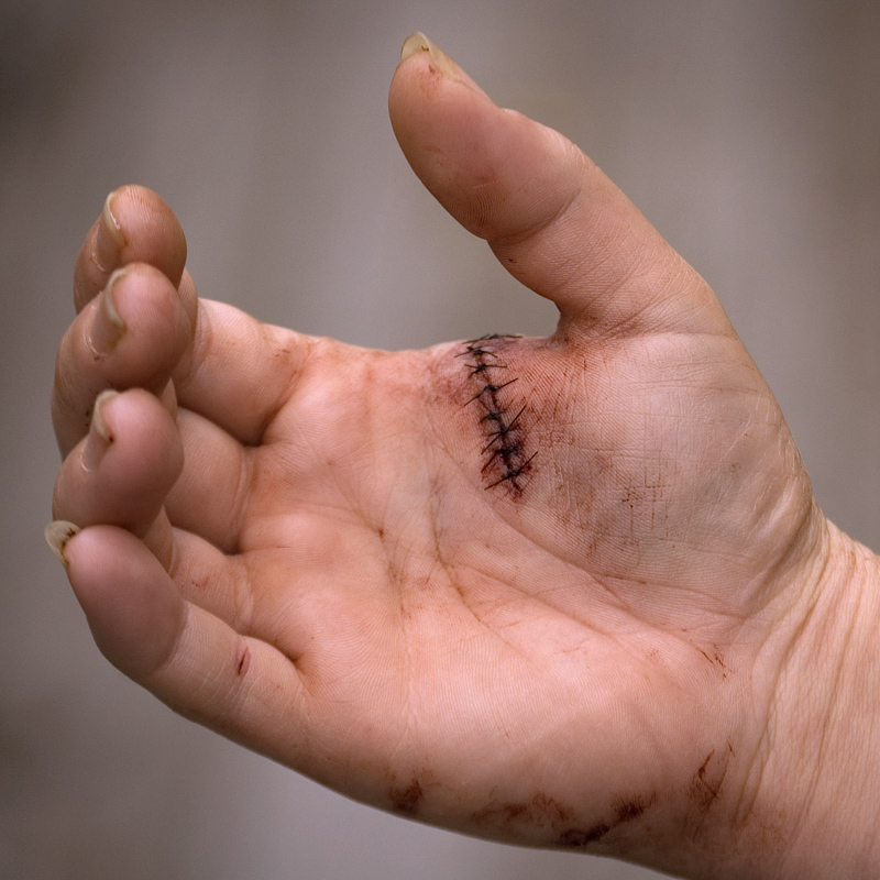 Beck's battle scars