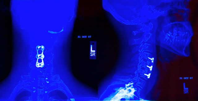 Post Surgery X-ray