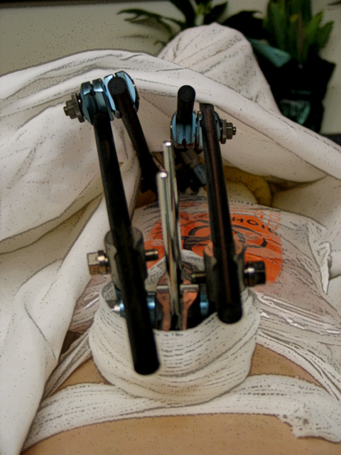Day-23-external-fixator.jpg