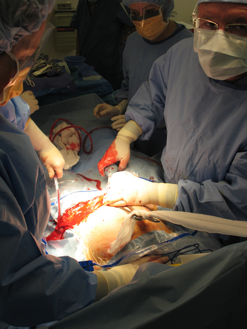 C-Section