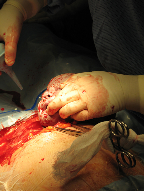 C-Section Birth