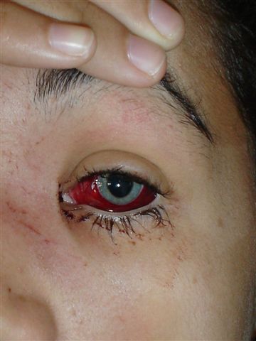 Injured  Eye